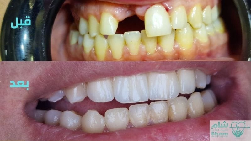 زراعة الأسنان الفورية في سوريا