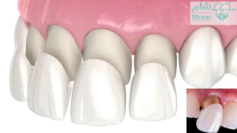 أنواع تلبيسات الأسنان في سوريا الفينير ,اللومينير ,الزيركون