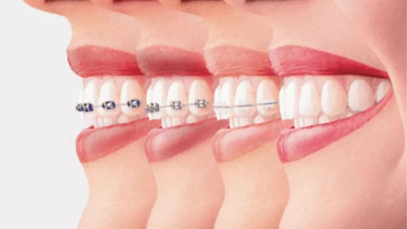 أنواع و اسعار تقويم الأسنان في سوريا