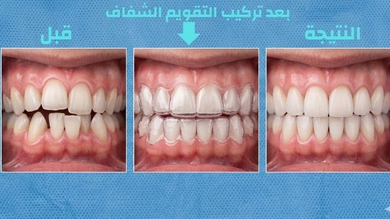 صورة واقعية لثلاث مراحل من علاج التقويم الشفاف في سوريا: الحالة قبل العلاج بأسنان مزدحمة، أثناء ارتداء القالب الشفاف، والنتيجة النهائية بأسنان مستقيمة ومثالية.