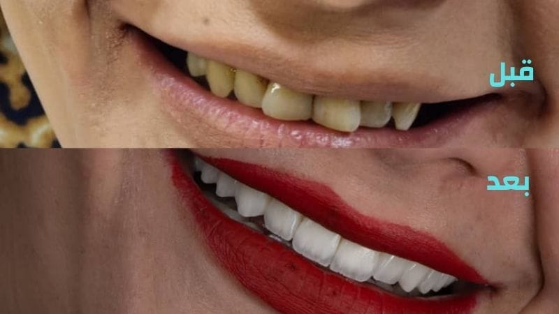 نتائج قبل وبعد تلبيس الأسنان في سوريا