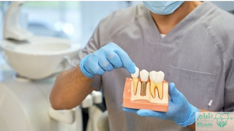 تكلفة زراعة الأسنان الفورية في سوريا