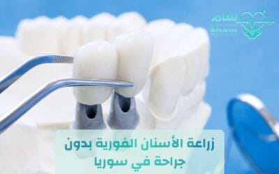 زراعة الأسنان الفورية في سوريا: استعد ابتسامتك في جلسة واحدة (2026)