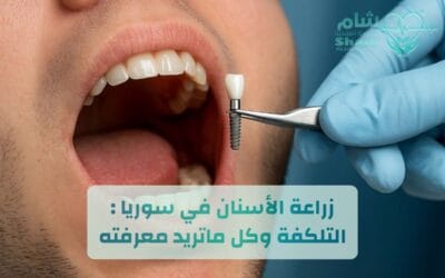 زراعة الأسنان في سوريا 2026 | خدمات طبية ولوجستية متكاملة