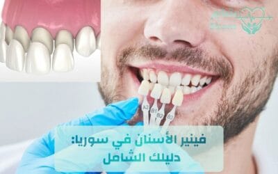 فينير الأسنان في سوريا: دليلك الشامل للأنواع وأحدث الأسعار لعام 2026