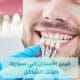 فينير الأسنان في سوريا