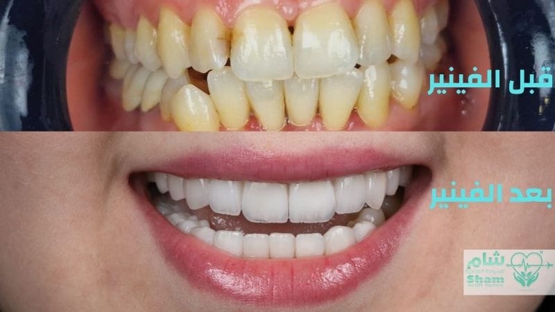 قبل وبعد تركيب الفينير في سوريا