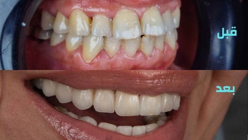 قبل وبعد تلبيس الأسنان في مركز تجميل الأسنان في سوريا