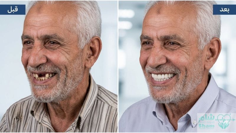 قبل وبعد زراعة الاسنان في سوريا