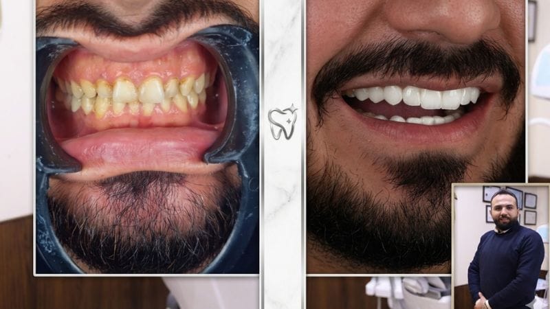 السياحة العلاجية في سوريا - أسعار أسنان زيركون في سوريا 2026