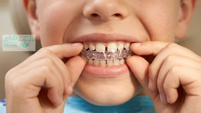 طبيب تقويم أسنان شفاف للأطفال في سوريا 2026