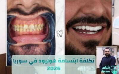 كم تكلفة ابتسامة هوليود في سوريا 2026 ؟  مقارنة الأسعار مع شام للسياحة العلاجية
