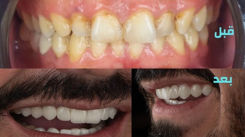 تبييض الأسنان بالليزر في سوريا 2026