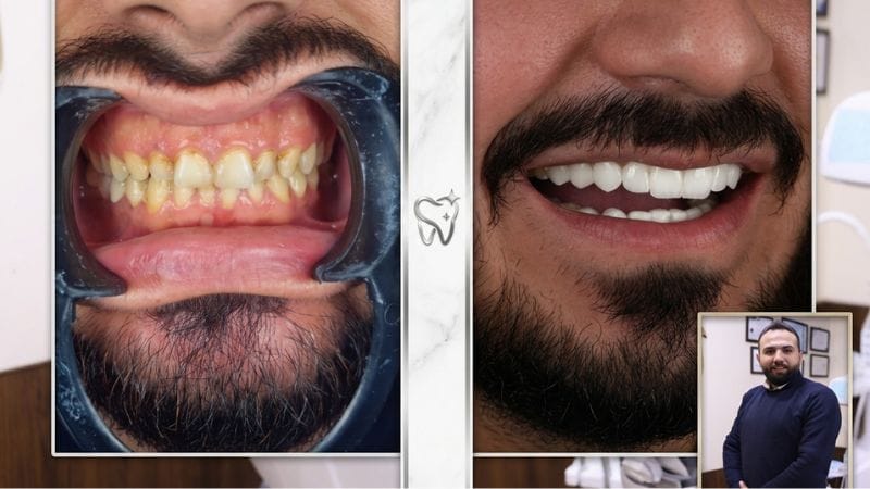 قبل وبعد تبييض الأسنان في سوريا , الدكتور وسيم طاوش