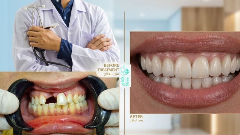 أفضل مركز زرع أسنان في سوريا 2026 قبل وبعد زراعة الأٍسنان